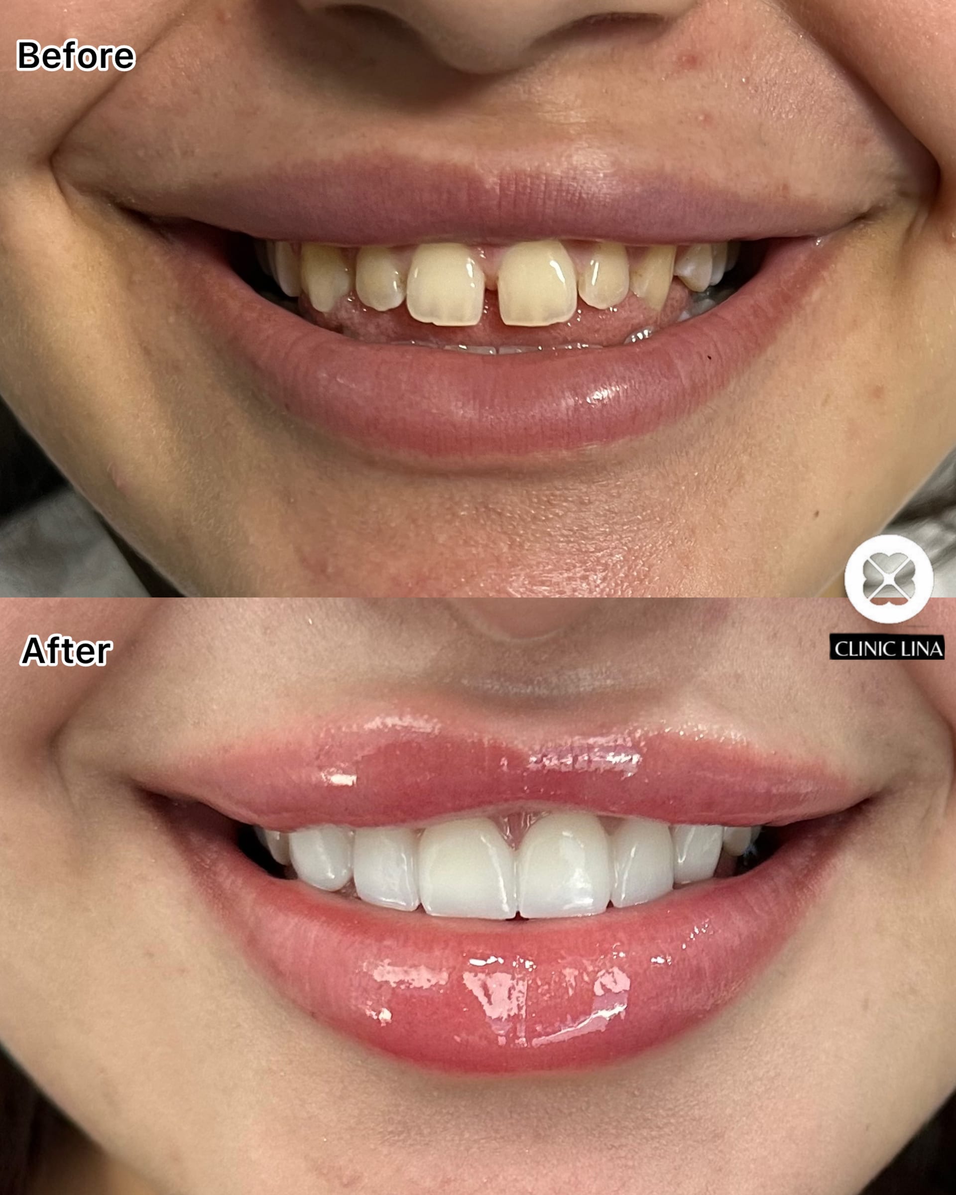 Invisalign